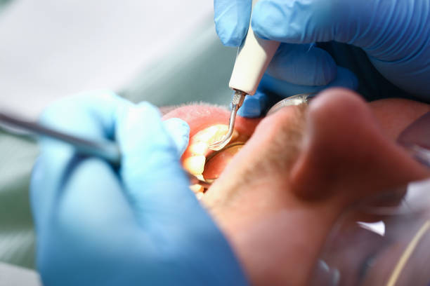 Best Emergency Tooth Extraction in Marinette, WI